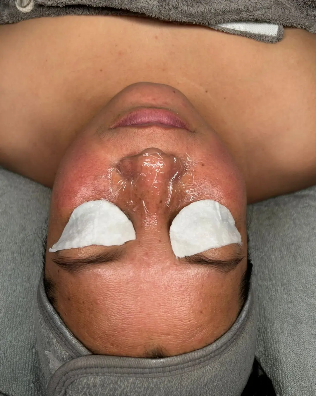 Caso 3 antes del tratamiento Sensitive & Barrier Repair