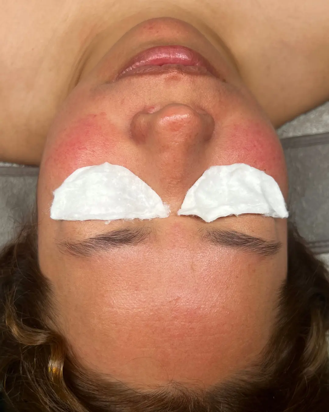 Caso 4 antes del tratamiento Sensitive & Barrier Repair