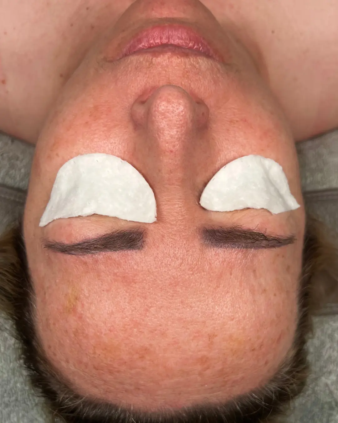 Caso 5 antes del tratamiento Sensitive & Barrier Repair