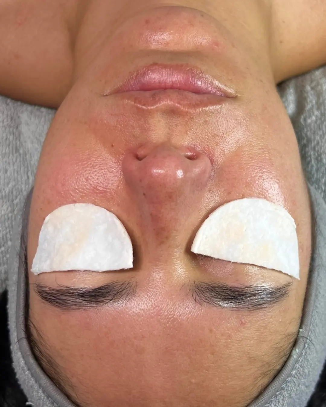 Caso 7 antes del tratamiento Sensitive & Barrier Repair