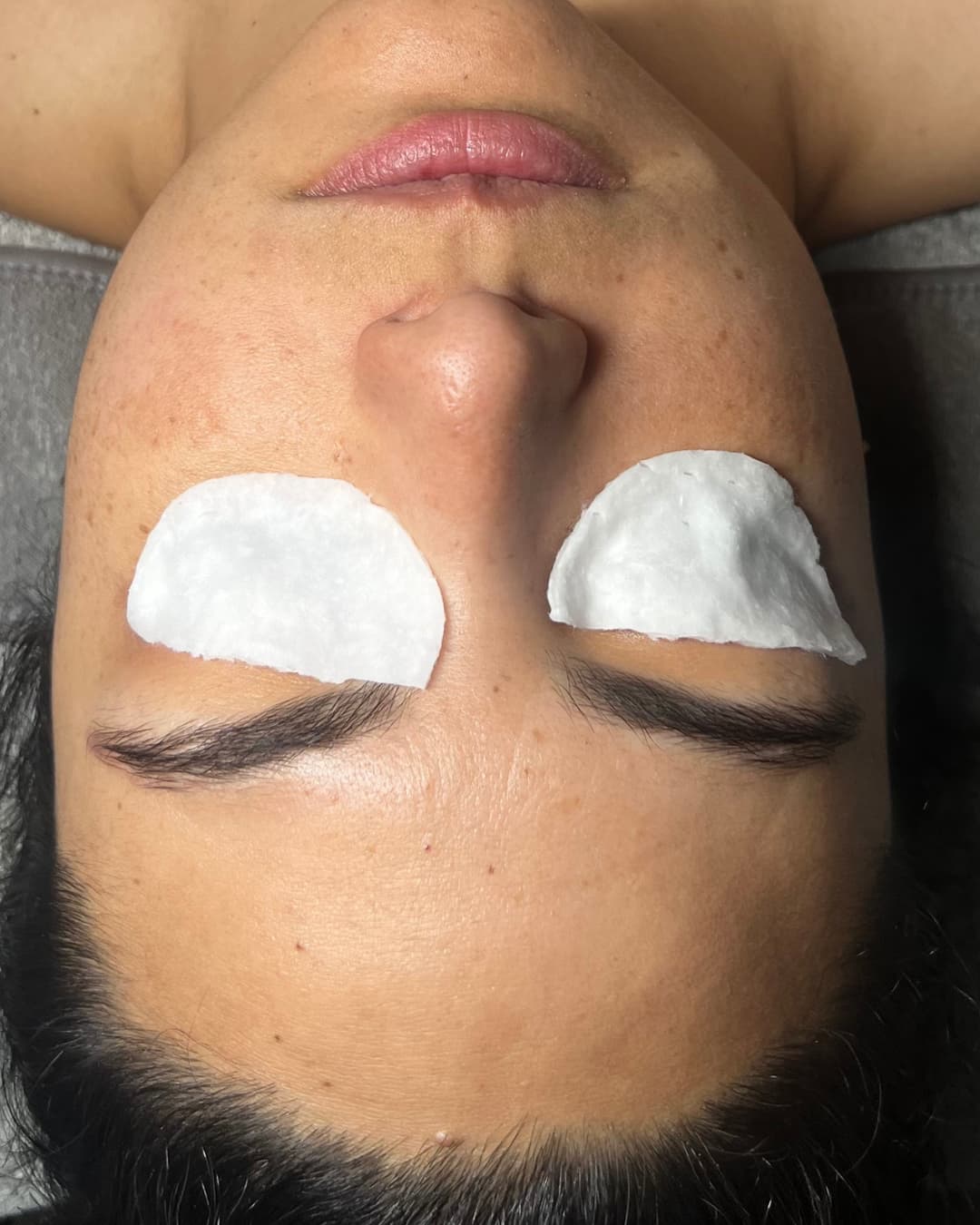 Caso 1 antes del tratamiento Deep Hydration & Glow