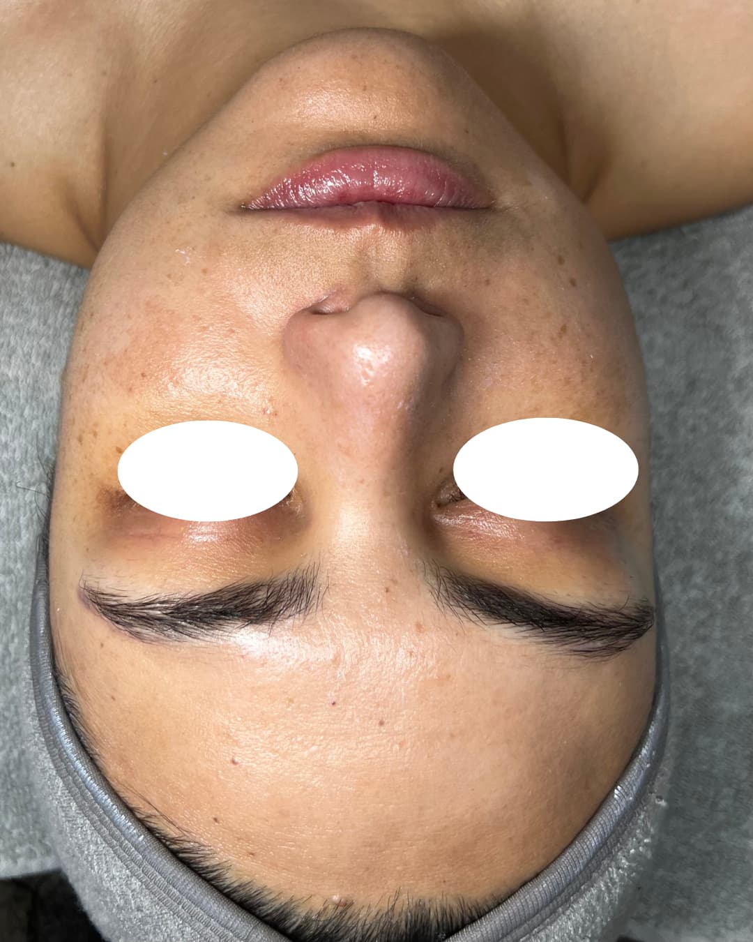 Caso 1 después del tratamiento Deep Hydration & Glow