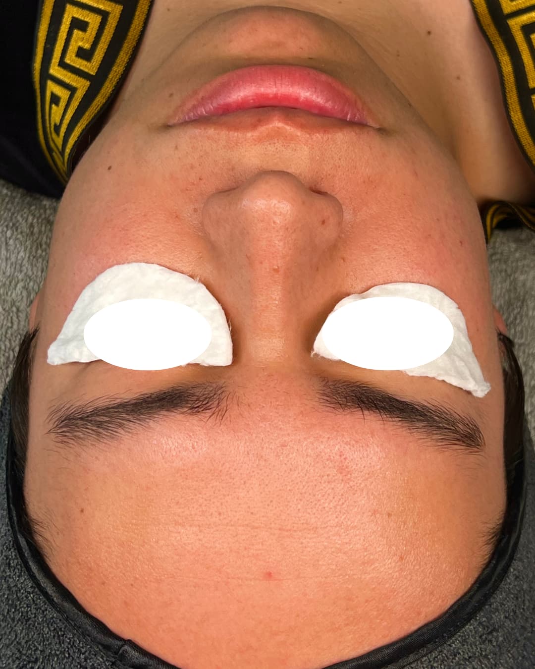 Caso 2 antes del tratamiento Deep Hydration & Glow