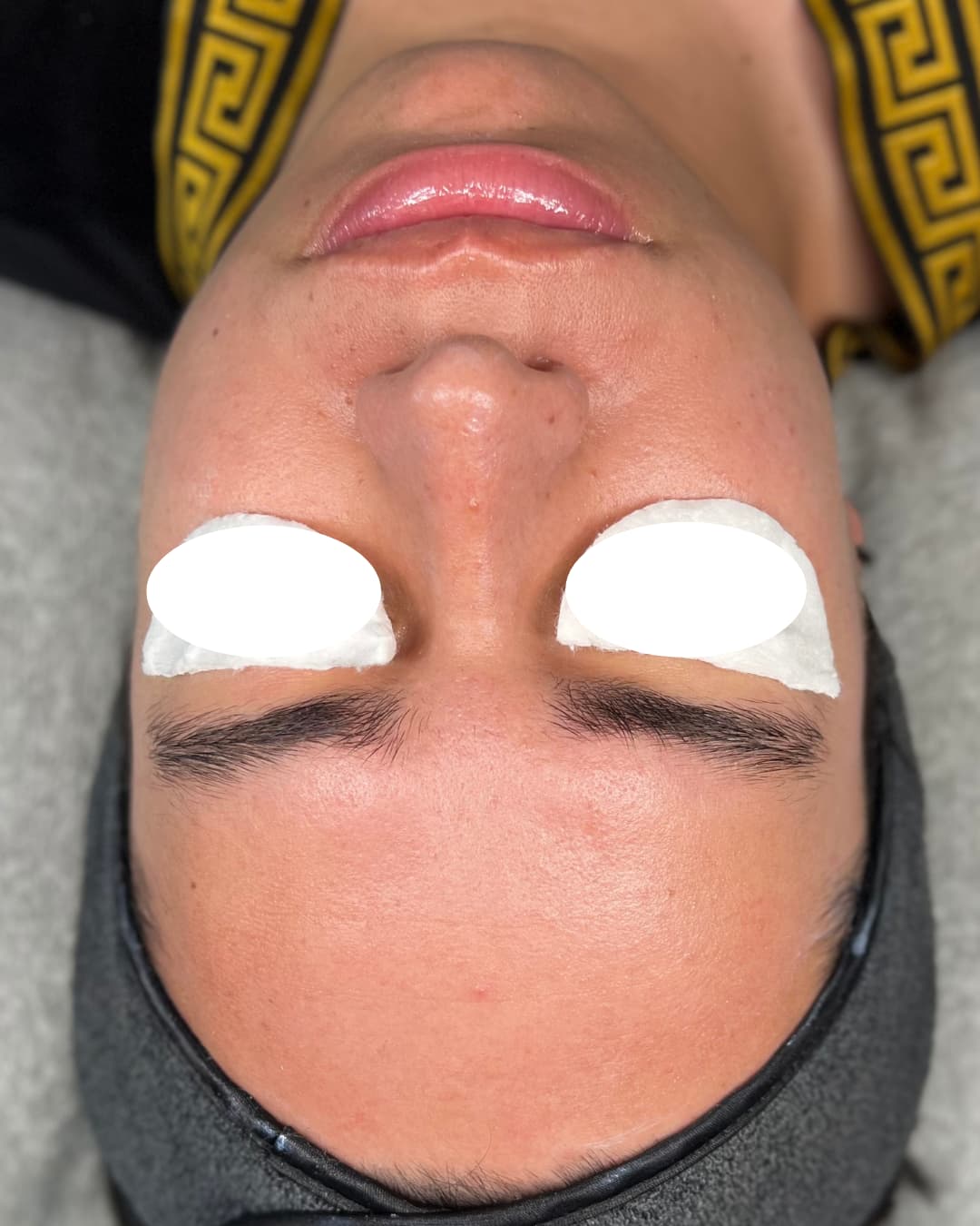 Caso 2 después del tratamiento Deep Hydration & Glow