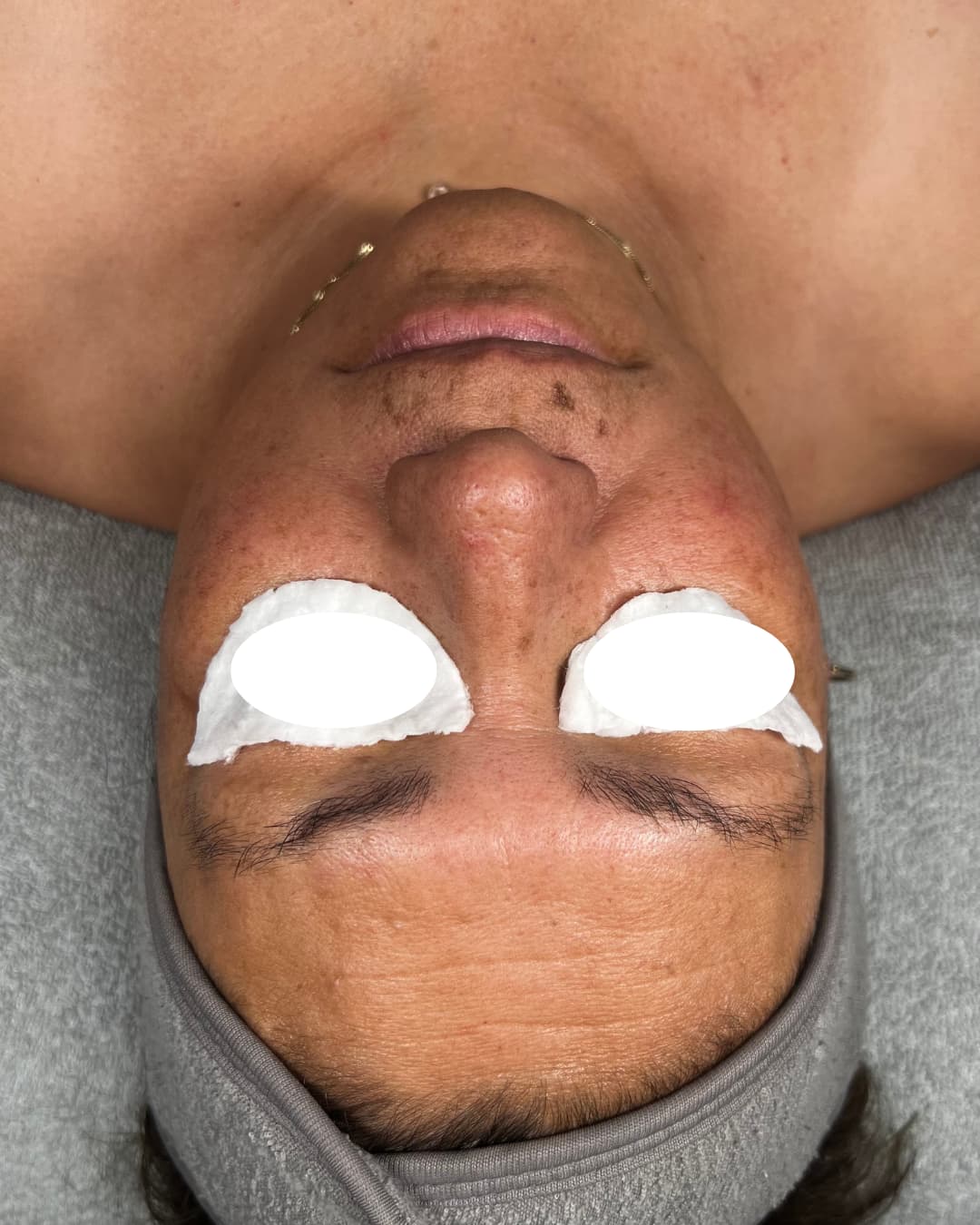 Caso 3 antes del tratamiento Deep Hydration & Glow