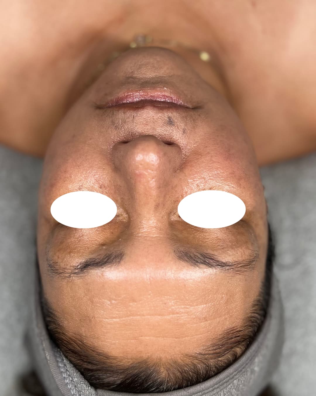 Caso 3 después del tratamiento Deep Hydration & Glow