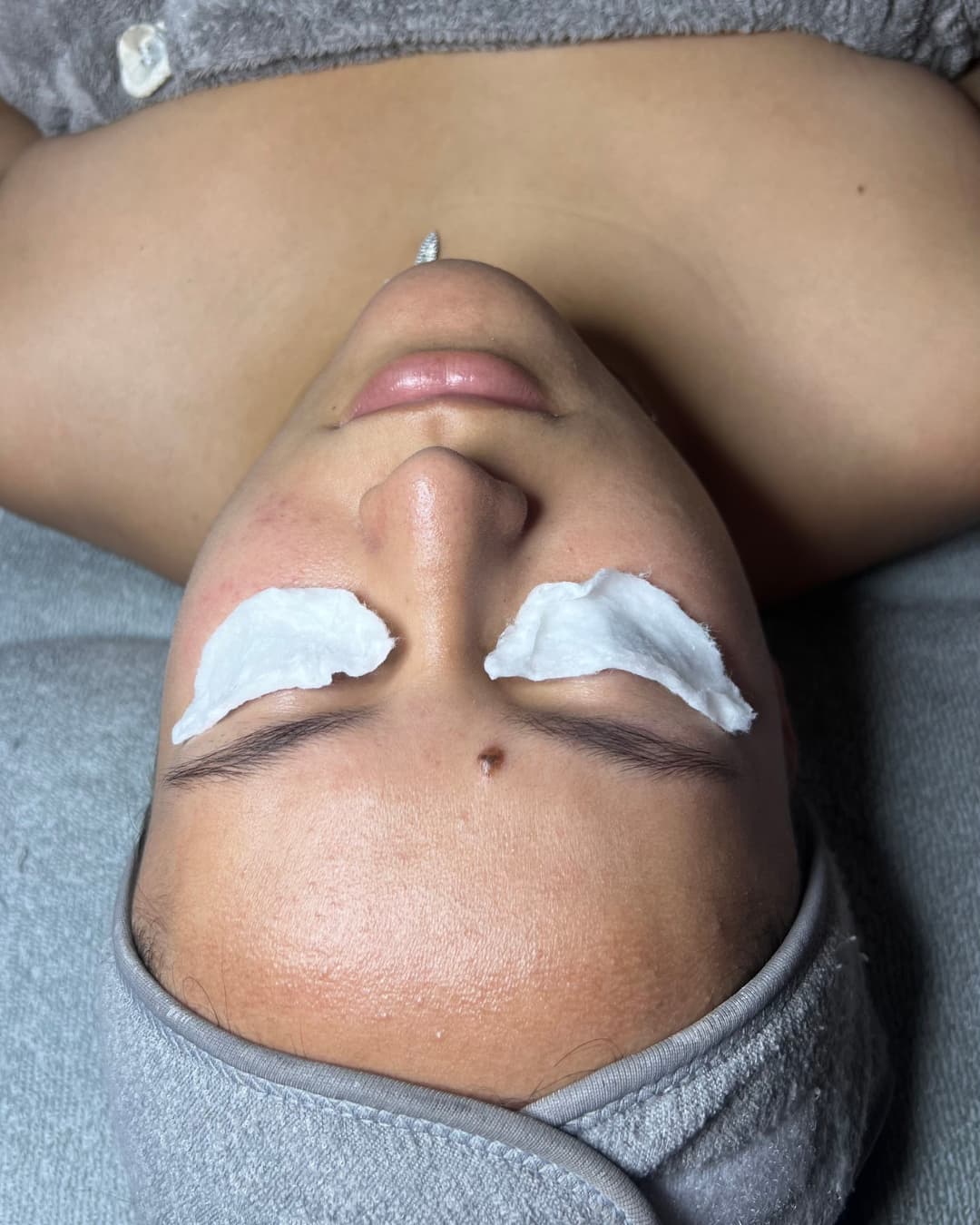 Caso 4 antes del tratamiento Deep Hydration & Glow