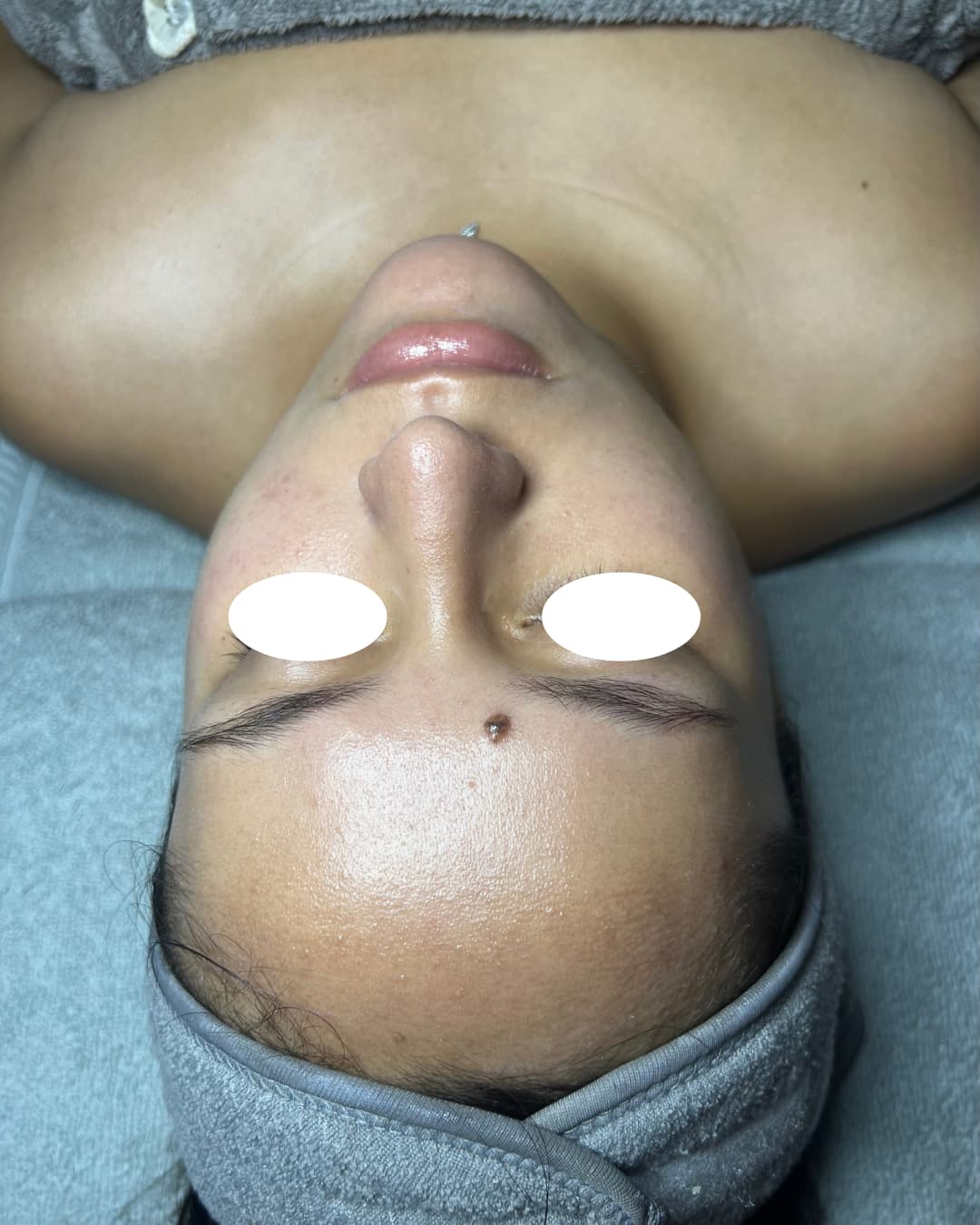 Caso 4 después del tratamiento Deep Hydration & Glow